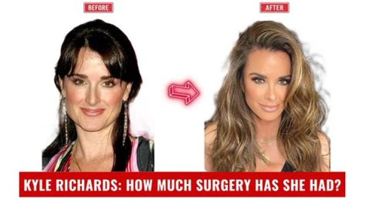 Has Kyle Richards Had Plastic Surgery? What the 'RHOBH' Star Has Said |