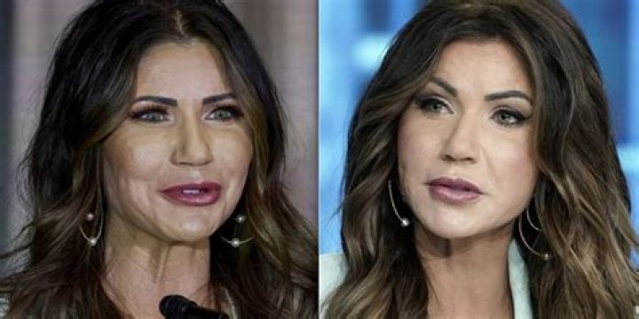 Kristi Noem Plastic Surgery- Before & After Pictures Depicts A Clear Difference