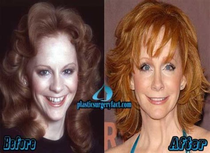 Reba McEntires Plastic Surgery: The Truth Behind Her Ageless Beauty